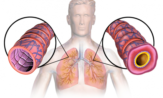 Asthma bronchiale