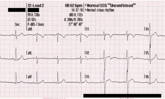 EKG